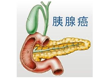 美國(guó)冷泉港實(shí)驗(yàn)室科學(xué)家利用胰腺癌的成癮性來(lái)開(kāi)發(fā)新型抗癌療法