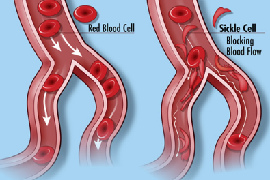 新的NIH研究尋求受鐮狀細(xì)胞病 性狀影響的成年人和家庭