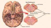 基因突變與帕金森病引發(fā)腦外疾病有關(guān)