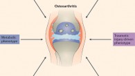 研究人員確定了9個(gè)骨關(guān)節(jié)炎新基因