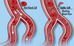 新的NIH研究尋求受鐮狀細(xì)胞病 性狀影響的成年人和家庭