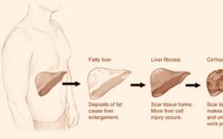 研究人員確定了導(dǎo)致肝纖維化的蛋白質(zhì)