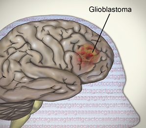 TCGA對膠質母細胞瘤腫瘤基因組的研究揭示了新的細節(jié)