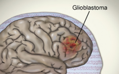 TCGA對(duì)膠質(zhì)母細(xì)胞瘤腫瘤基因組的研究揭示了新的細(xì)節(jié)