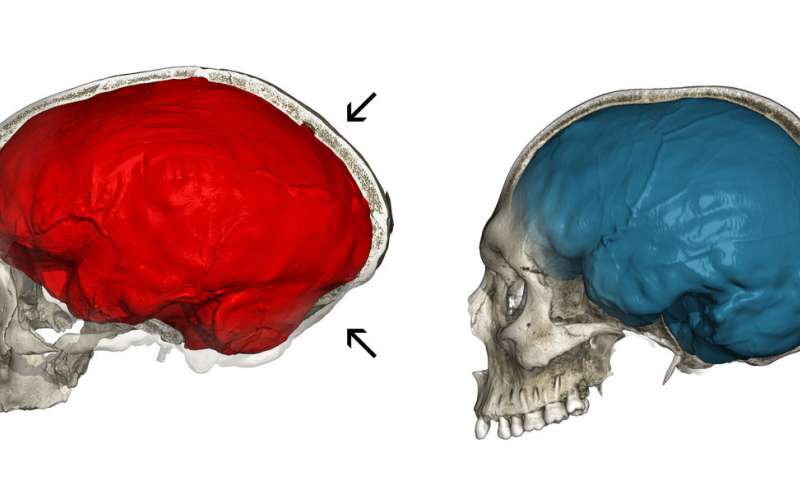 穴居人基因揭示現(xiàn)代人類大腦的獨特的方面