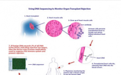 用DNA測序監(jiān)測器官移植排斥反應(yīng)