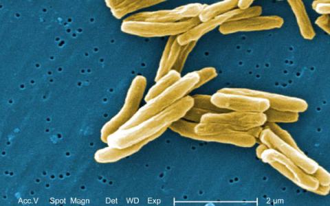 研究人員確定了對結(jié)核病脆弱性負責(zé)的遺傳變異