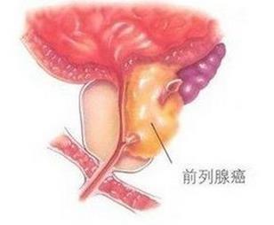 前列腺癌預測看起來機器學習準確性提升