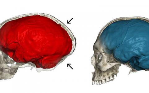 尼安德特基因揭示了現(xiàn)代人類大腦的獨特方面
