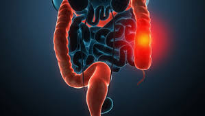 BiomX推廣治療痤瘡和炎癥性腸病藥物