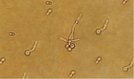 新型抗菌藥VT-1161啟動(dòng)第3個(gè)III期研究 治療外陰陰道念珠菌病