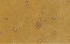 新型抗菌藥VT-1161啟動第3個III期研究 治療外陰陰道念珠菌病