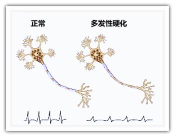 科學家發(fā)現(xiàn)治療多發(fā)性硬化的新機制