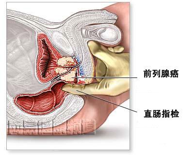 前列腺癌細(xì)胞是如何變得抵抗藥物治療的