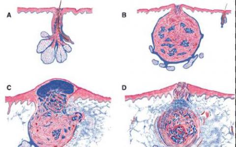鼠標模型提供了對痤瘡起源的洞察力