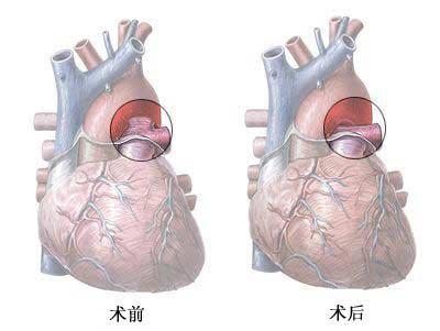 算法創(chuàng)新可能有助于減少侵入性心臟手術(shù)