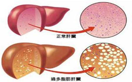 新分子可以幫助對抗2型糖尿病和非酒精性脂肪性肝病