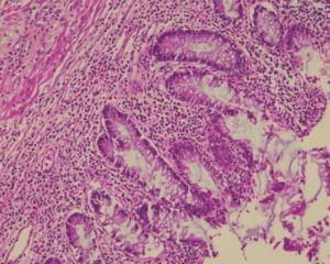 Gut-Nibbling Amoeba Evades檢測Hannibal Lecter風格