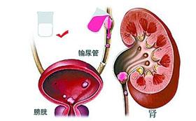 科學家發(fā)現(xiàn)第一個涉及下尿路梗阻的基因