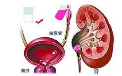 科學家發(fā)現(xiàn)第一個涉及下尿路梗阻的基因