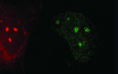 糖尿病藥物有助于修復(fù)“月亮兒童”細(xì)胞中受紫外線損傷的DNA