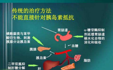 大型研究將罕見的DNA改變與2型糖尿病聯(lián)系起來