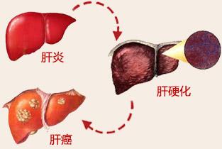 未感染的患者是否應(yīng)該接受丙型肝炎感染的肝臟以減少等待時(shí)間