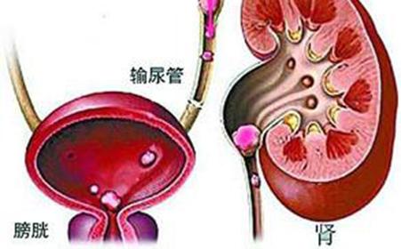 新發(fā)現(xiàn)可以改善腎結(jié)石疾病的診斷和早期篩查