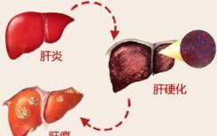 未感染的患者是否應該接受丙型肝炎感染的肝臟以減少等待時間