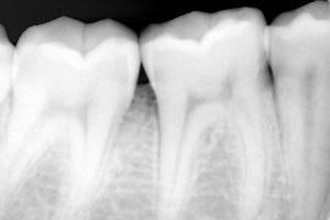 研究人員開發(fā)出可以再生牙釉質的新礦化材料