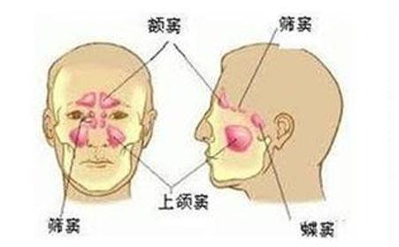 老年患者的獨(dú)特慢性鼻竇炎形式