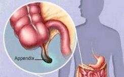 發(fā)現(xiàn)闌尾炎和過(guò)敏癥之間的聯(lián)系