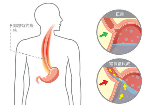 用于檢測Barrett食管的可吞咽裝置接受FDA 510（k）許可