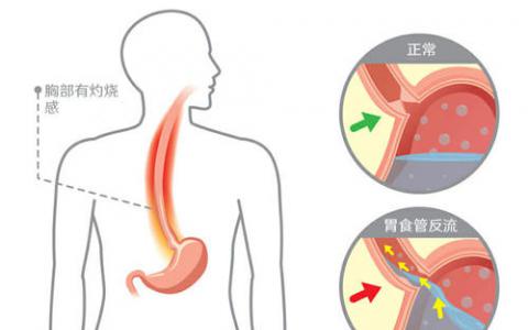 用于檢測Barrett食管的可吞咽裝置接受FDA 510（k）許可