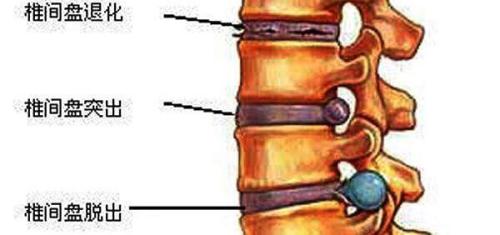 預(yù)防椎間盤突出癥的裝置在挫折后獲得PMA