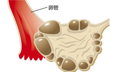 中國研究人員找到治療多囊卵巢綜合征的新目標