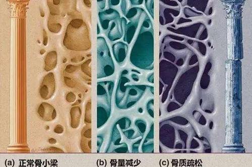 研究調查了英格蘭和威爾士與骨質疏松性骨折有關的趨勢