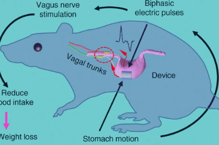 植入式迷走神經(jīng)刺激裝置有助于減肥