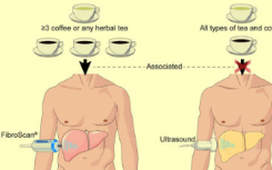 食用咖啡 涼茶可預(yù)防肝纖維化