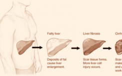 研究人員確定了引起肝纖維化的蛋白