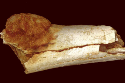 南非化石揭示了人類最早的人癌證據(jù)