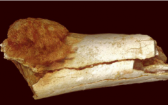 南非化石揭示了人類(lèi)最早的人癌證據(jù)