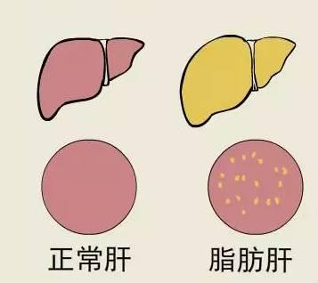 識別非酒精性脂肪肝患者的新工具