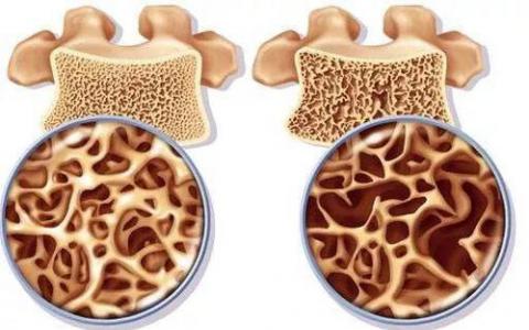 71％的髖部骨折患者未告知自己患有骨質(zhì)疏松癥