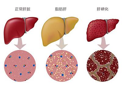 非酒精性脂肪肝患者的2型糖尿病治療的其他益處