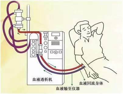 血液透析的歷史為有限的醫(yī)療資源的道德使用提供了啟示