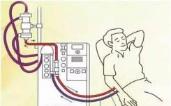 血液透析的歷史為有限的醫(yī)療資源的道德使用提供了啟示