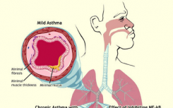 研究人員找到預防急性哮喘癥狀的新方法