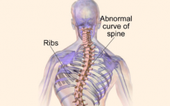嚴重脊柱側彎與必需飲食礦物質(zhì)錳有關