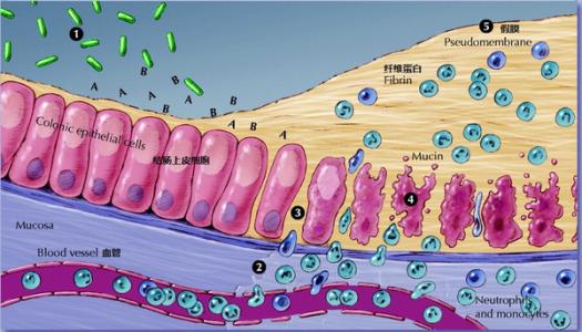 入院的近十分之一患者被發(fā)現(xiàn)為艱難梭菌攜帶者